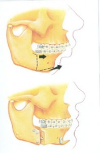Jaw surgery to correct retruded lower jaw @ pineypointoms.com