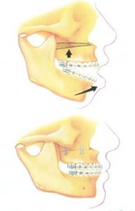 Jaw surgery to correct open bite @ pineypointoms.com