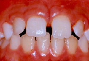 The size of the small tooth has been increased with composite bonding material
