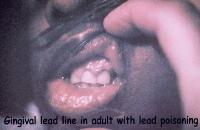 Lead poisoning Â© emedicine