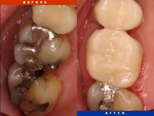Interested in the different types of Porcelain Dental Crowns