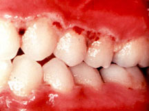 Acute necrotizing gingivitis Â© Too Smile Dentals