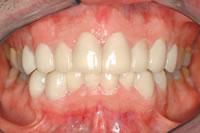 Porcelain veneers are used here to mask the stains and elongate the tooth