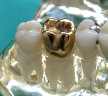 gold crown, dental crown, crown
