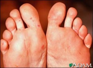 Lesions seen on the sole of the foot
