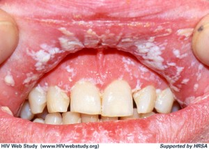 Pseudomembranous Candidiasis (Thrush) on Lips and Gums Â© University of Washington