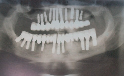 implants, implant , dental implants, dental implant cost
