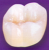 porcelain crown, dental crown