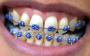 A female mouth with braces.