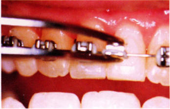 Detached bracket from tooth