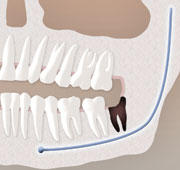 Impacted 3rd molar