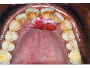 oral pyogenic granuloma