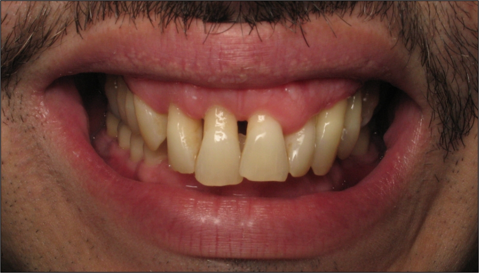 gingival flap