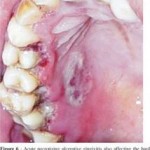Ulcers