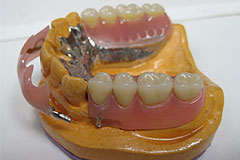 Swing lock partial dentures | Intelligent Dental