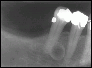 Radiographic Appearance of Cysts Part 2 | Intelligent Dental