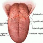 Bald tongue | Intelligent Dental