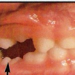 Arrow showing submerged tooth